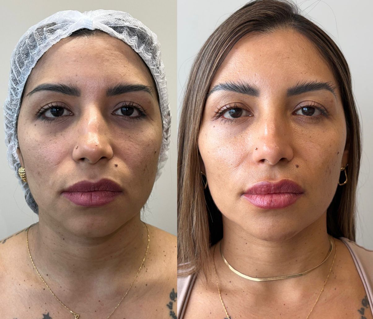 Harmonização facial — resultado 1