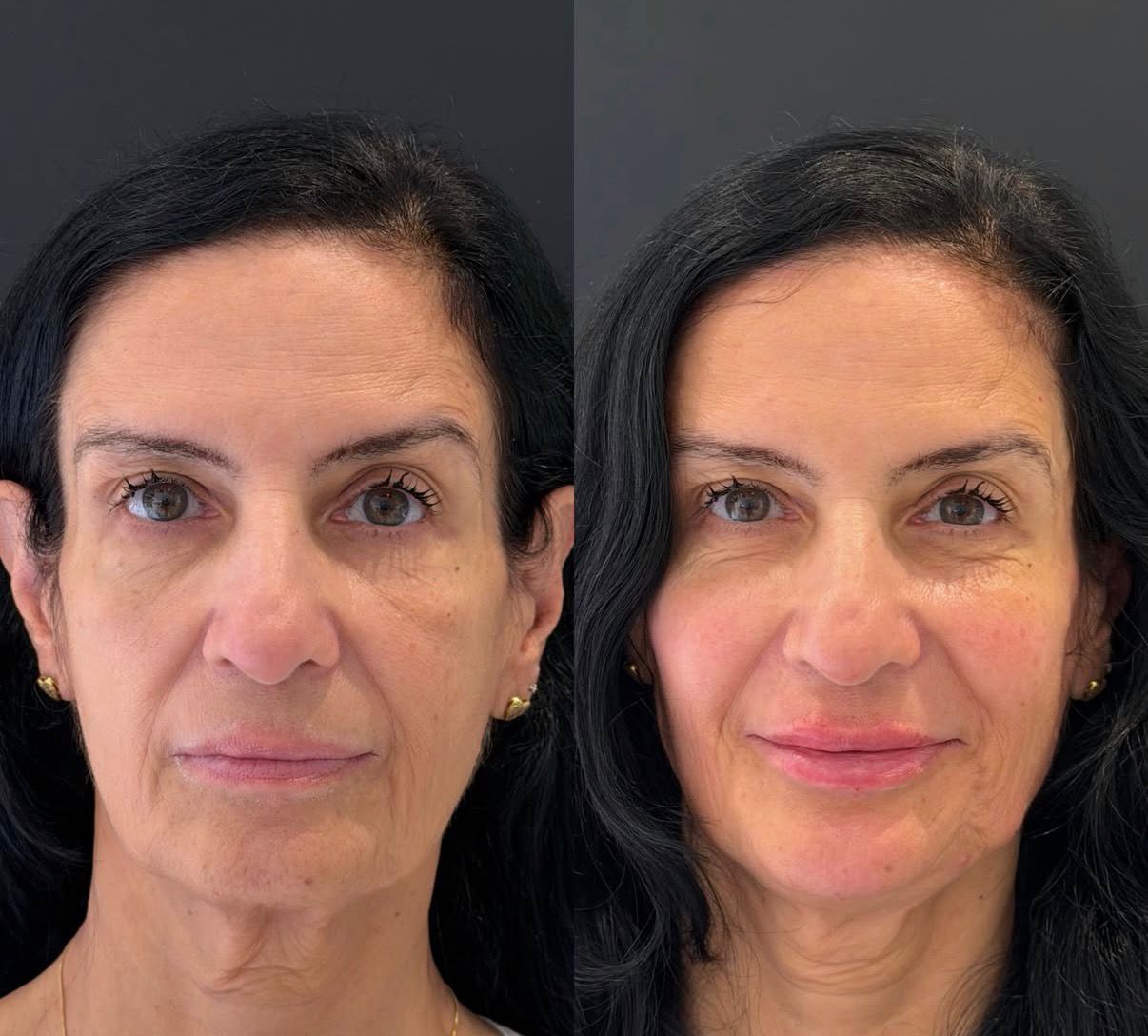 Harmonização facial — resultado 4