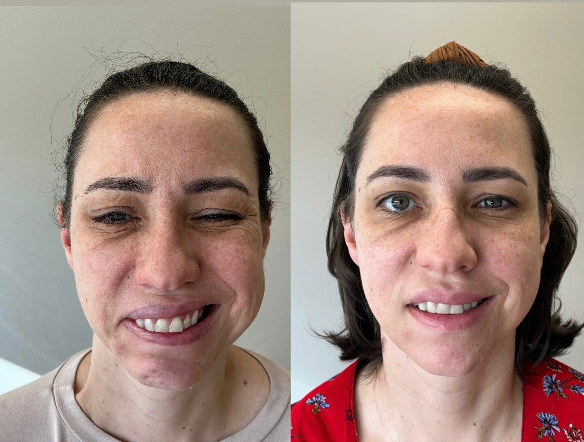 Gabriela — antes e depois paralisia facial