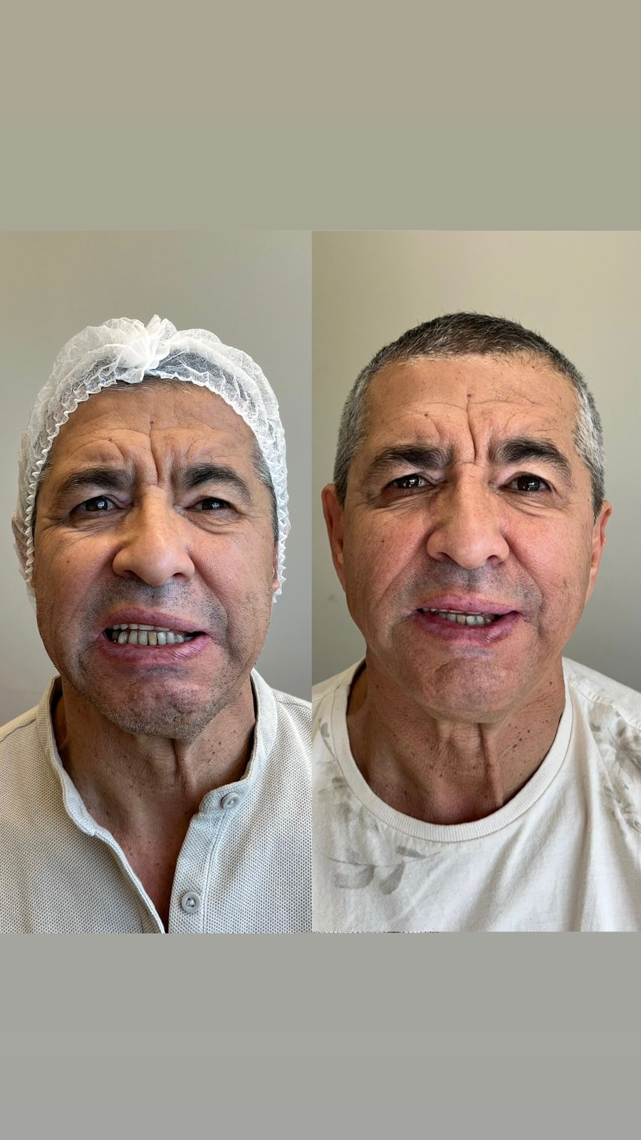 Roni — caso de paralisia facial antes e depois