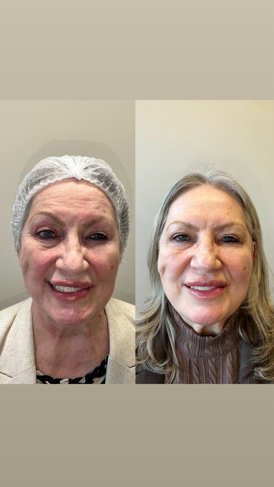 Erondina — antes e depois paralisia facial