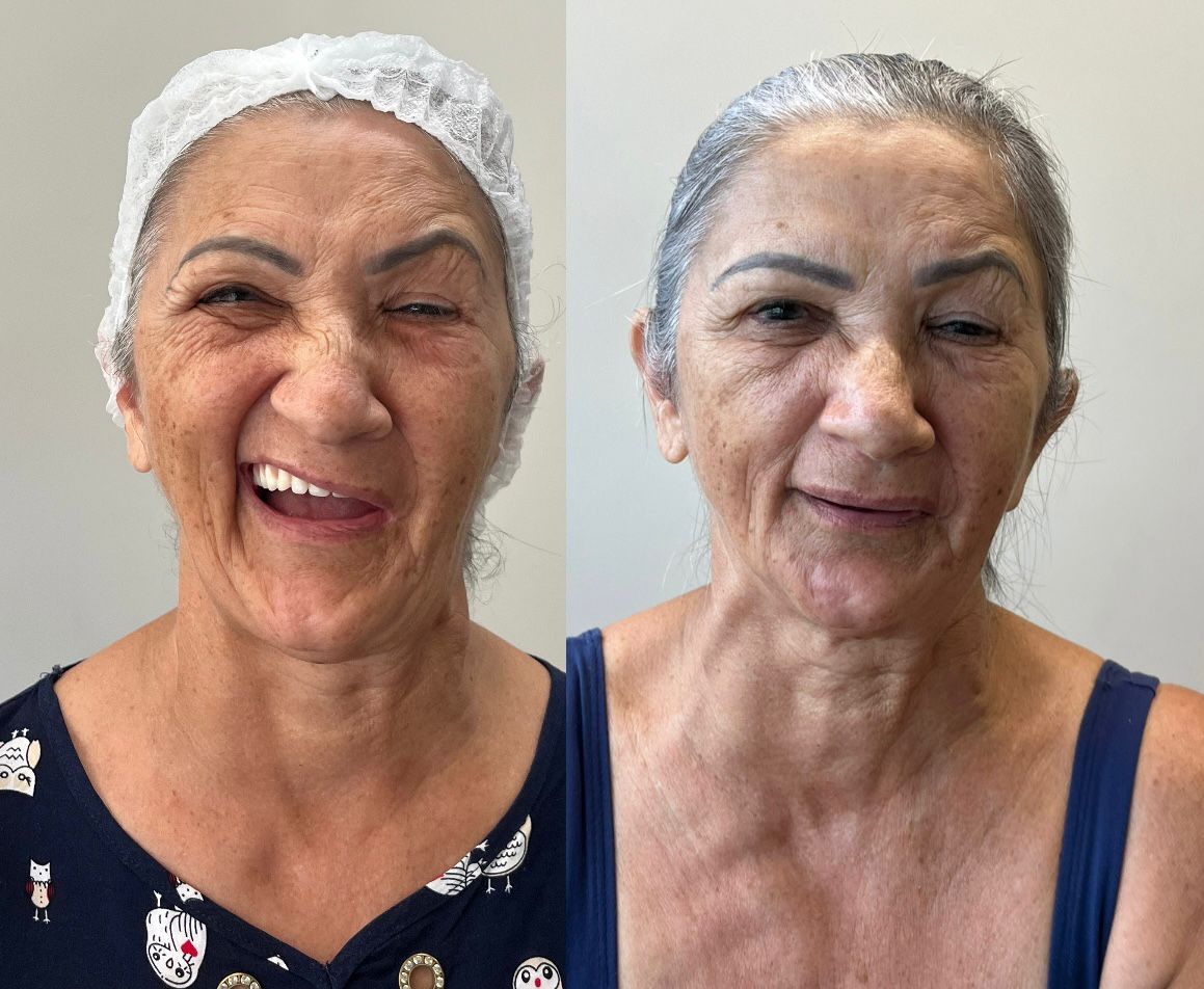 Nelicia — caso de paralisia facial antes e depois